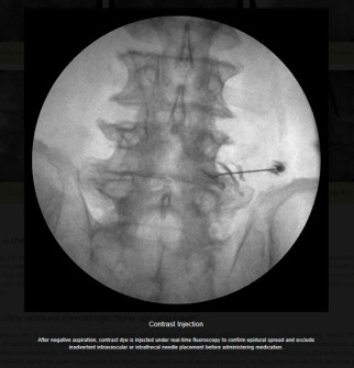 A Fluoroscopy Guided Image, while performing The Transforaminal Epidural MIPSI