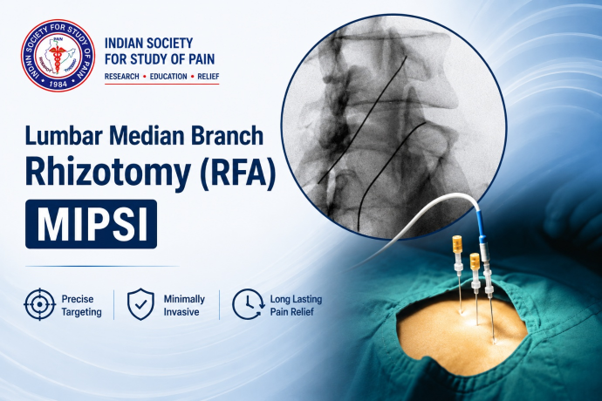 Lumbar Medial Branch Rhizotomy (RFA) MIPSI performed under fluoroscopic guidance by a Pain Physician for chronic low back pain